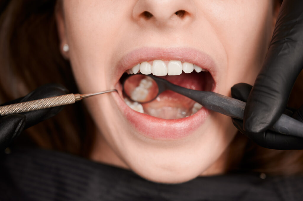 Close-up, cropped snapshot of good looking woman at dentist office during teeth checkup. Dentist examining patient's teeth with mirror and explorer. Oral hygiene concept
